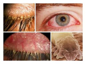 symptomen van de aanwezigheid van parasieten onder de menselijke huid